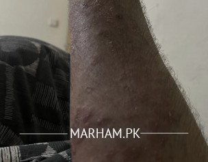 Skin Problem