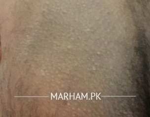 Rash Or Jock Itch ? 