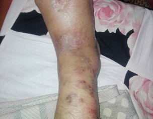 Skin Problem 