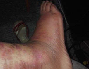 Skin Problem 