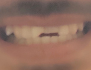Broken Teeth