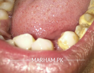 Dental Problem
