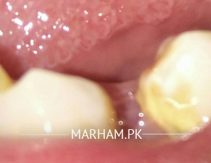 Dental Problem