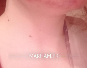 Acne Problem