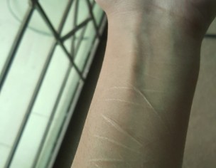 Scars From Self Harm