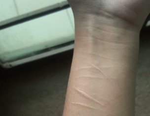 Scars From Self Harm