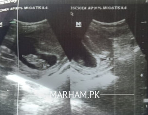 Pregnancyy