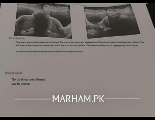 Miscarriage