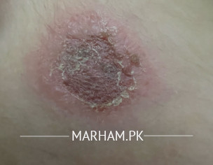 Rash Or Lump