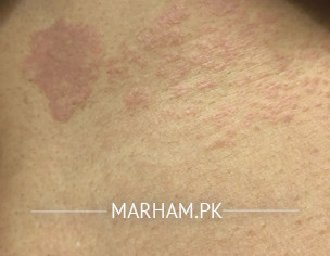 Skin Spots