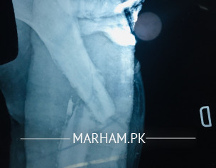 Bone Fracture 