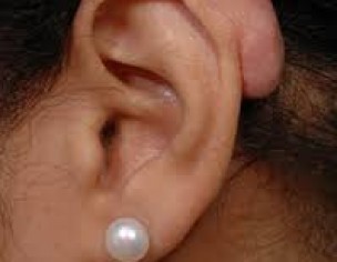 Keloid 