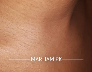 Skin Tiny Bumps