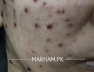 Chicken Pox Scar