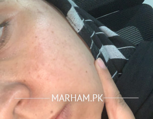 Pigmentation 