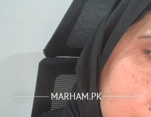 Pigmentation 