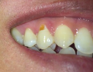 Tooth