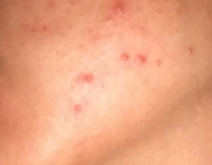 Acne 