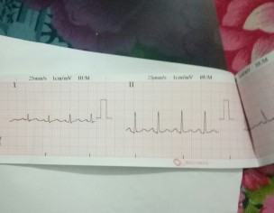 ECG Report