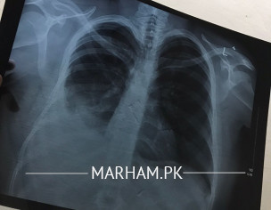 Pleural Effusion