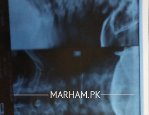 C Spine Xray