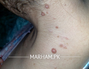 Warts
