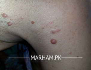 Warts