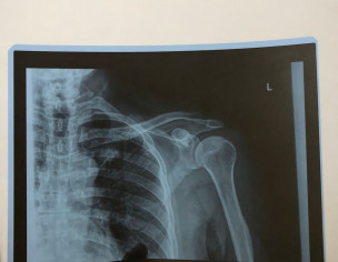Joint Dislocation