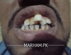 Tooth Alignment