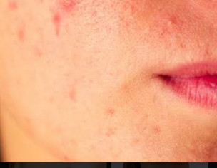 Skin Problem