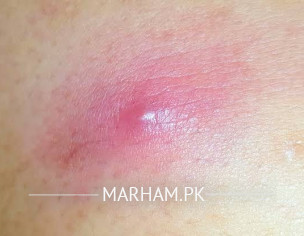 Bumps Pimple 
