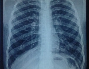 Chest X-ray Analysis