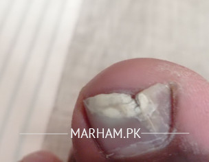 Nail Problem
