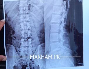 Back Pain