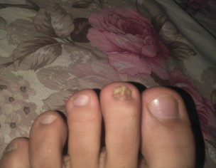 Nail Problem