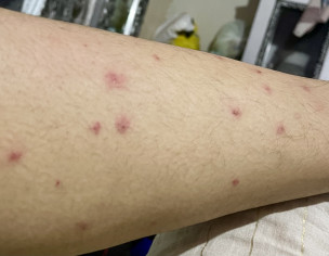 Itchy Skin