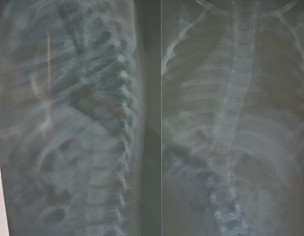 Spinal Cord