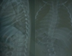 Spinal Cord
