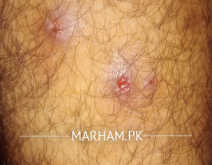 Skin Problem