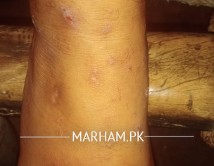 Skin Problem