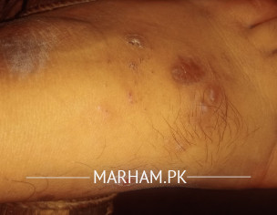 Skin Problem