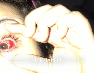 Eye Conjunctivitis 