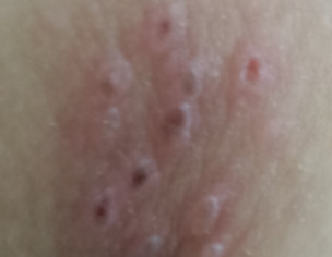 Skin Problem
