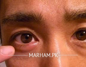 Eyes Issues And Headache