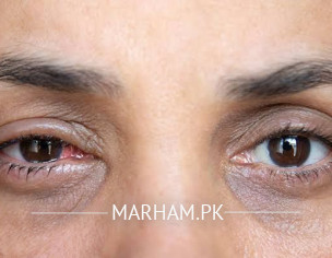 Eyes Issues And Headache