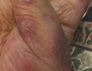 Skin Issue