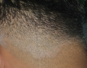Skin/SCALP ISSUE