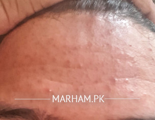 Forehead Sudden Pimples Spurt