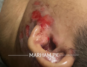 Allergic, Kharish