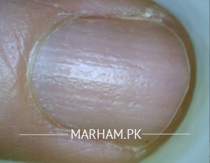 Nail Pitting
